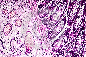 Bacillary dysentery, light micrograph