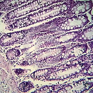 Bacillary dysentery, light micrograph