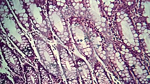 Bacillary dysentery, light micrograph photo