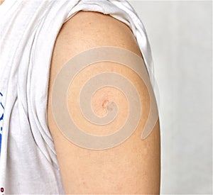 Bacillus Calmette-GuÃÂ©rin, BCG or TB vaccine scar in left arm of Southeast Asian, Burmese adult young man. photo