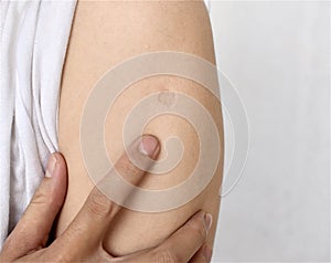:Bacillus Calmette-GuÃÂ©rin, BCG or TB vaccine scar in right arm of Southeast Asian, Burmese adult y photo