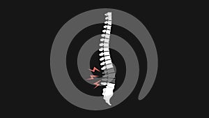 Back ache animated illustration with spine. Focused on spine vertebra region