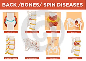 Back, bones and human spin diseases explanation vector