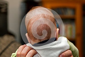 Back of Head of a Baby Who Had a Possible Diagnosis of Craniosynostosis