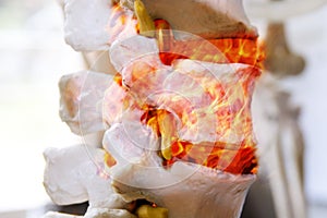Back pain. Colorful anatomy of spine in fire