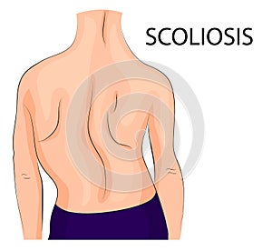 Back, a scoliosis of the fourth degree photo