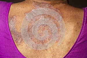 Back of woman with psoriasis close up stock photo photo