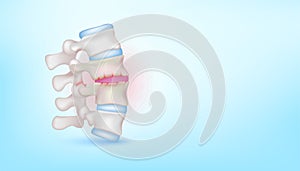 Backbone disc joint degeneration herniation cartilage on blue background with copy space for text.
