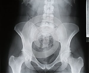 Backbone, pelvis, socket of hip joint, thigh bone x-ray, osteoporosis