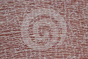 Background of skin texture close-up covered with small and large cracks and dead dry flaky scales after sun exposure