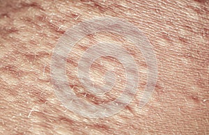 background of the texture human skin is covered with fine wrinkles ,cracked and blistered from the burn and allergies