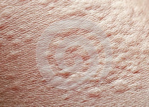 Background of the texture unhealthy irritated human skin is covered with fine wrinkles ,cracked and blistered from the burn and