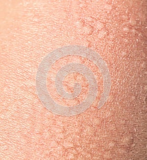 Background of the texture unhealthy irritated human skin covered with small wrinkles ,cracks and blistering