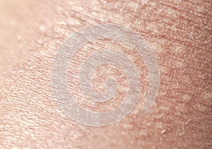 Background of the texture unhealthy irritated human skin covered with small wrinkles ,cracks and blistering