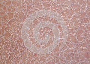 Background of unhealthy skin texture close-up covered with small and large cracks and dead dry flaky scales