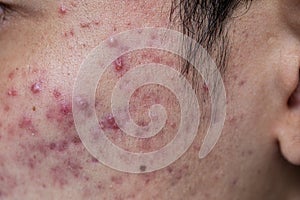 Backgrounds of lesions skin caused by acne on the face.