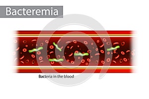 Bacteremia is the presence of bacteria in the blood. photo