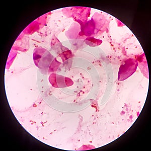 Bacteria cell Gram neagative bacilli with capsule.Sample sputum in Gram stain method