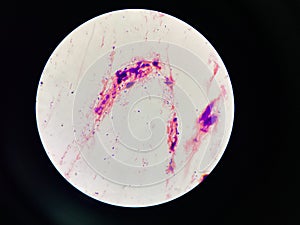 Bacteria cell in sputum sample Gram stain method