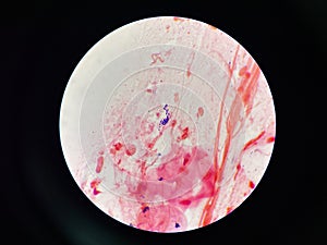 Bacteria cell in sputum sample Gram stain method