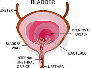 Bacteria in urinary bladder or simply bladder. Green small cell which causes inflammation.