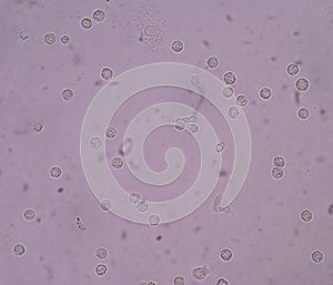 Bacteria in urine specimen