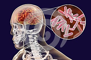 Bacterial brain infection medical concept, meningitis, encephalitis