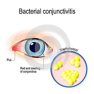 Bacterial conjunctivitis