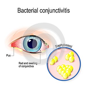 Bacterial conjunctivitis photo