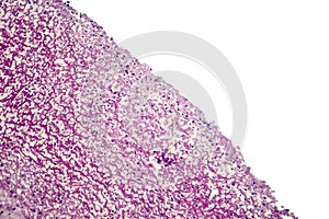 Bacterial dysentery, light micrograph