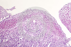 Bacterial dysentery, light micrograph