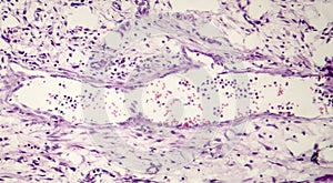 Bacterial dysentery, light micrograph