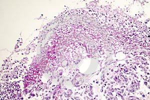 Bacterial dysentery, light micrograph