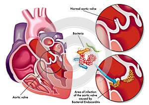 Bacterial endocarditis