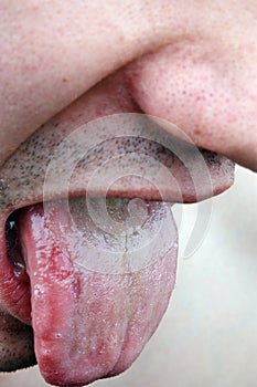 Bacterial infection disease tongue