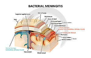 Bacterial meningitis photo