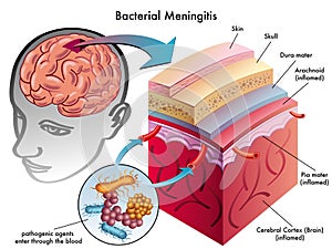 Bacterial meningitis