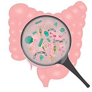 Bacterial overgrowth in small intestine