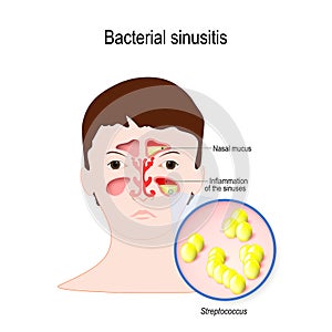 Bacterial sinusitis. Rhinitis