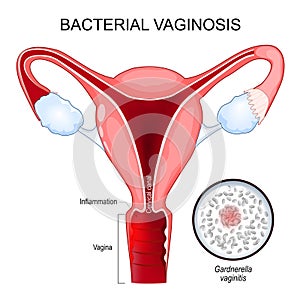 Bacterial vaginosis. Cross section of Human uterus. Close-up of G. vaginalis. photo