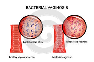 Bacterial vaginosis. the vagina and the causative agent