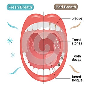 Bacteria produce halitosis for dental hygiene and personal care use. cleaning tooth and tongue maintain dental hygiene photo