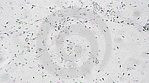 Bad spermogram of male semen under microscope magnified 400 times on white background