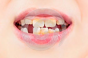 Bad teeth child. Portrait boy with bad teeth. Child smile and show her crowding tooth. Close up of unhealthy baby teeths