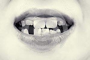 Bad teeth child. Portrait boy with bad teeth. Child smile and show her crowding tooth. Close up of unhealthy baby teeths