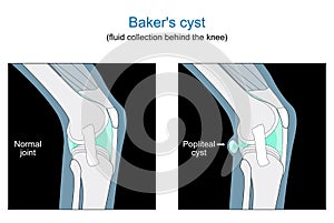 Baker`s cyst. knee joint