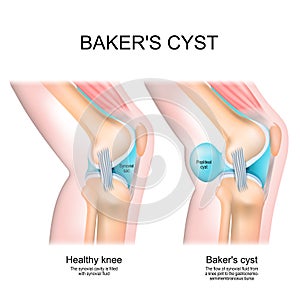 Baker`s cyst. Normal knee, and joint with Popliteal cyst photo