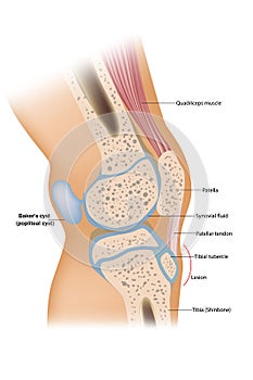 Baker cyst or popliteal cyst. Traumatology and orthopedics photo