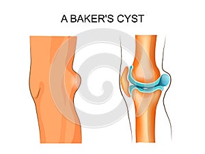 A Baker`s cyst photo