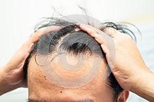 Bald at front of head and begin no loss hair glabrous of mature Asian business smart active office man